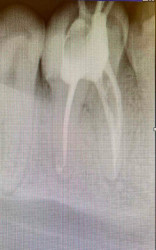 Периодонтит