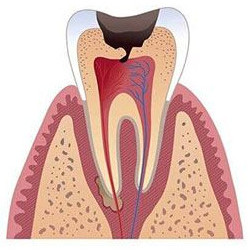 Периодонтит